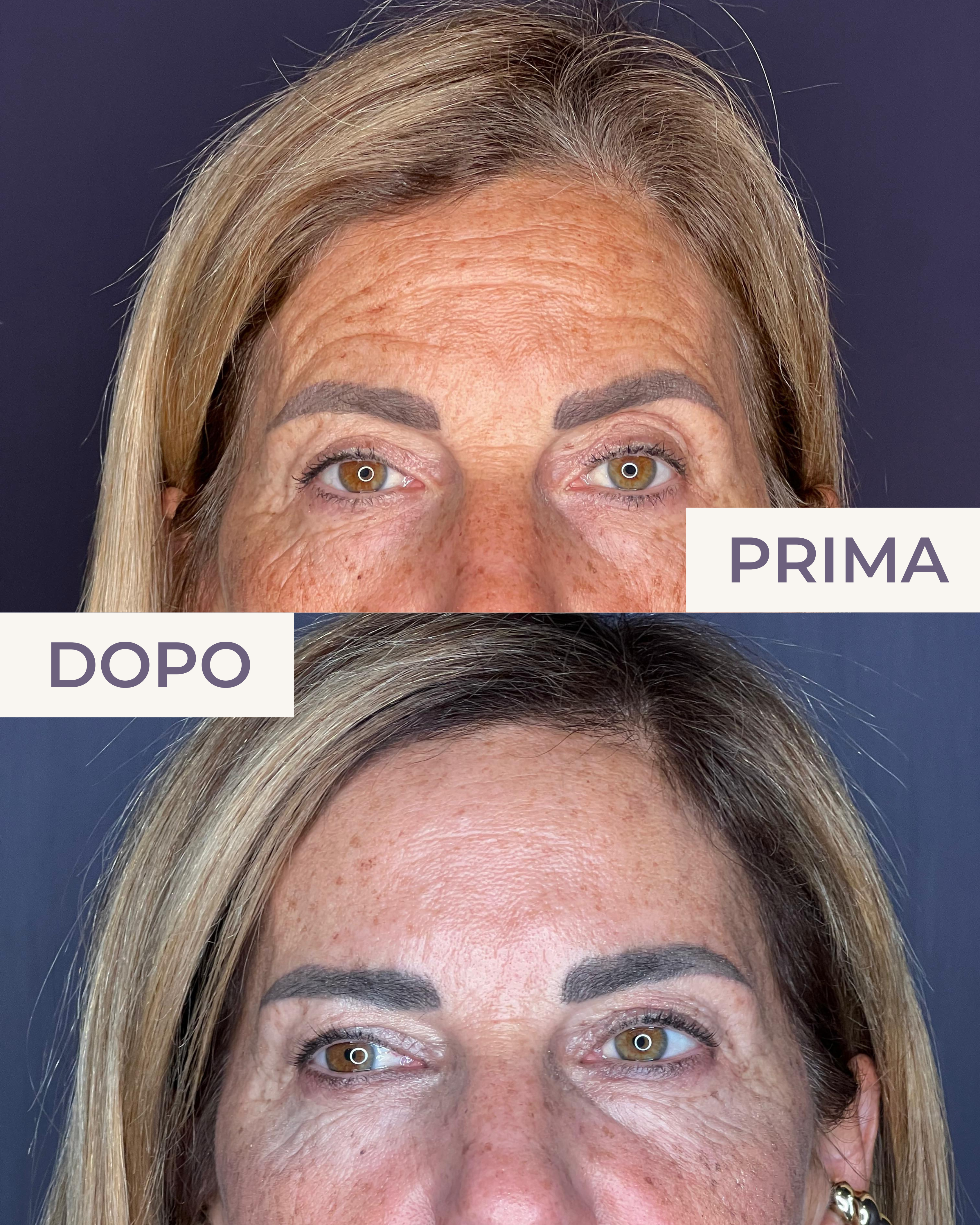 Trattamento BOTOX