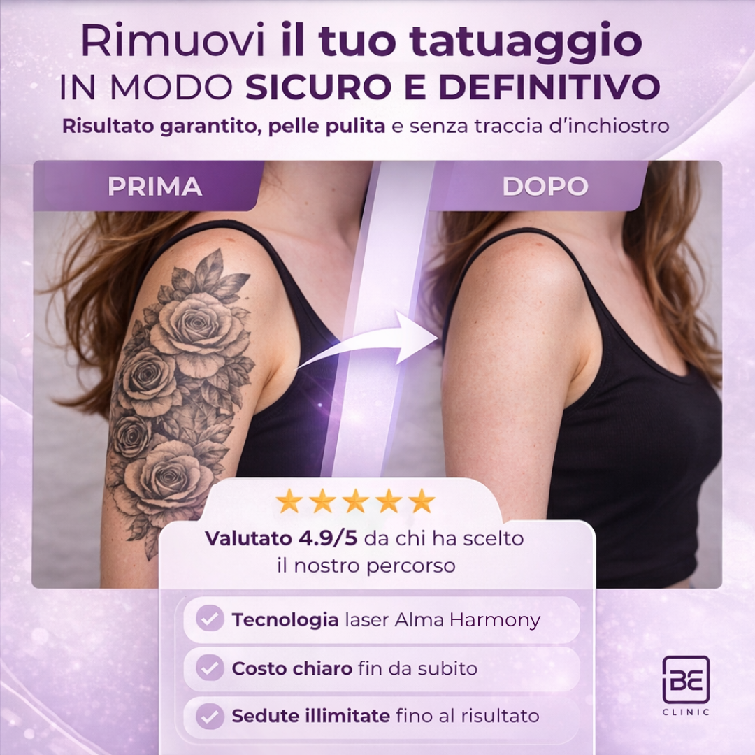 Rimuovi il tuo Tatuaggio con il laser Harmony
