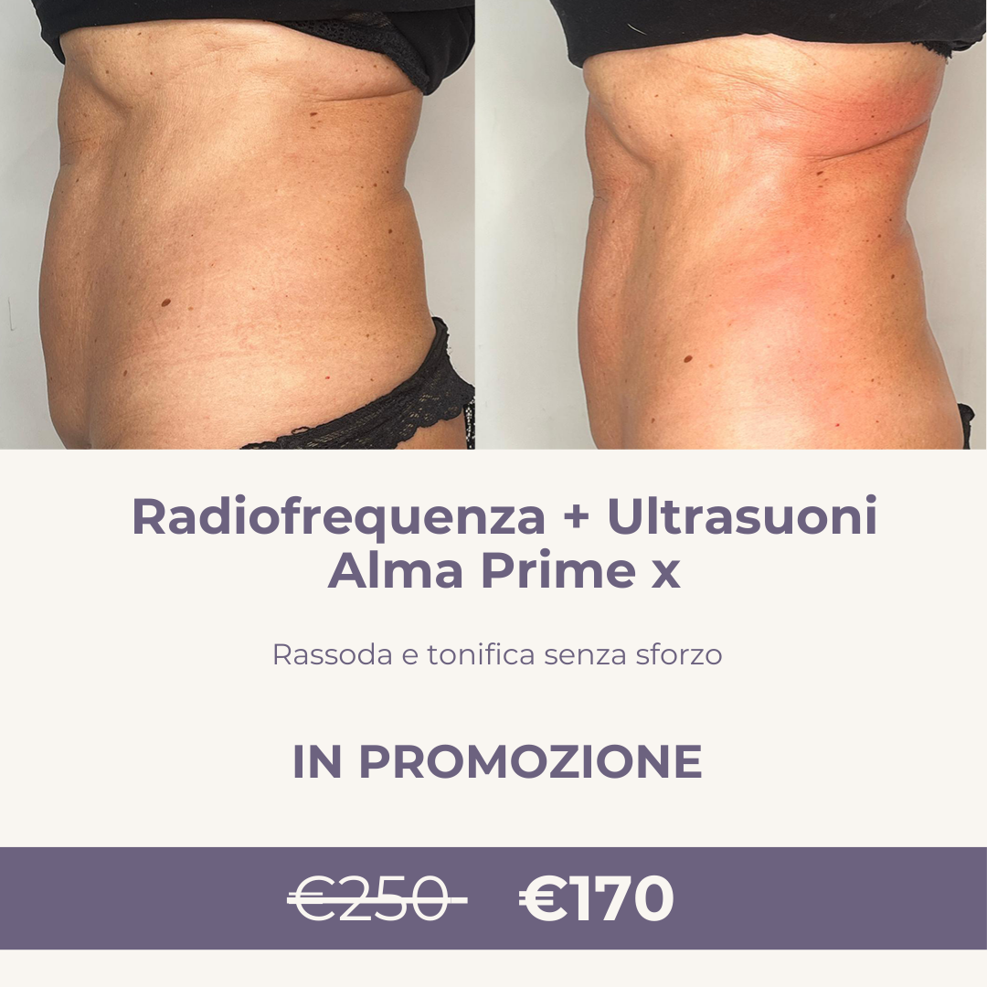 Radio Frequenza  + Ultrasuoni Alma Prime X
